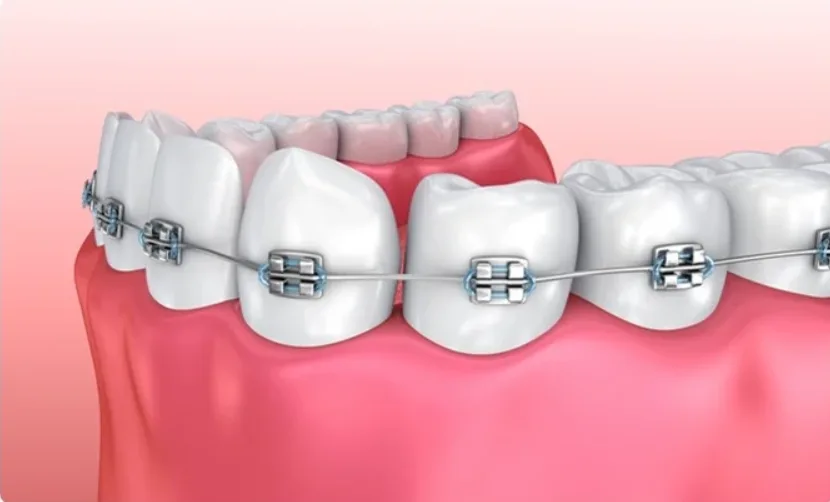 Orthodontic Braces & Aligners